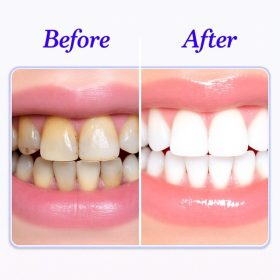 Kávézás Elleni Fogfehérítő Krém 100g